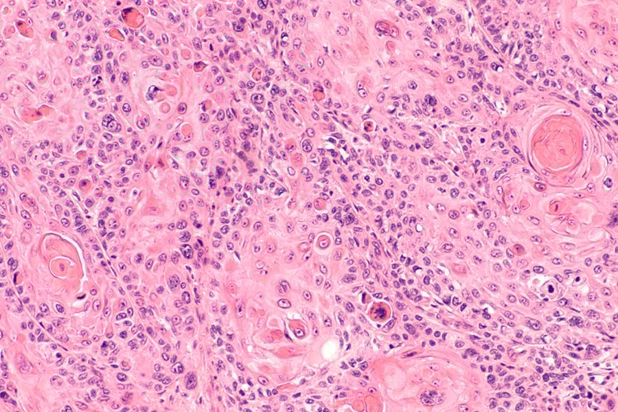 tipos-de-vph