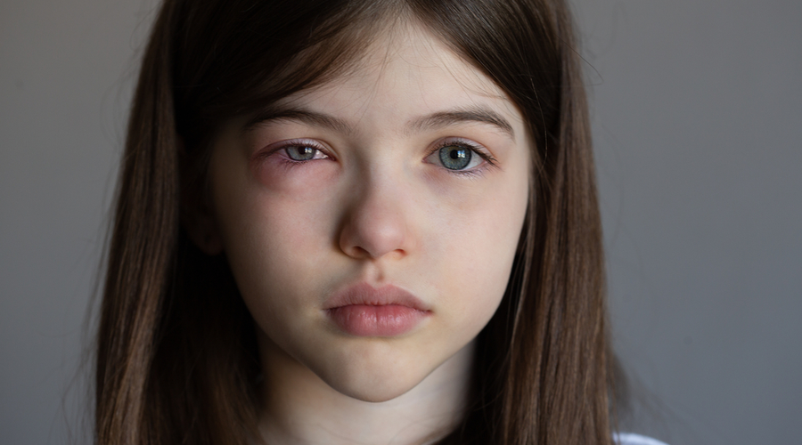 conjuntivitis