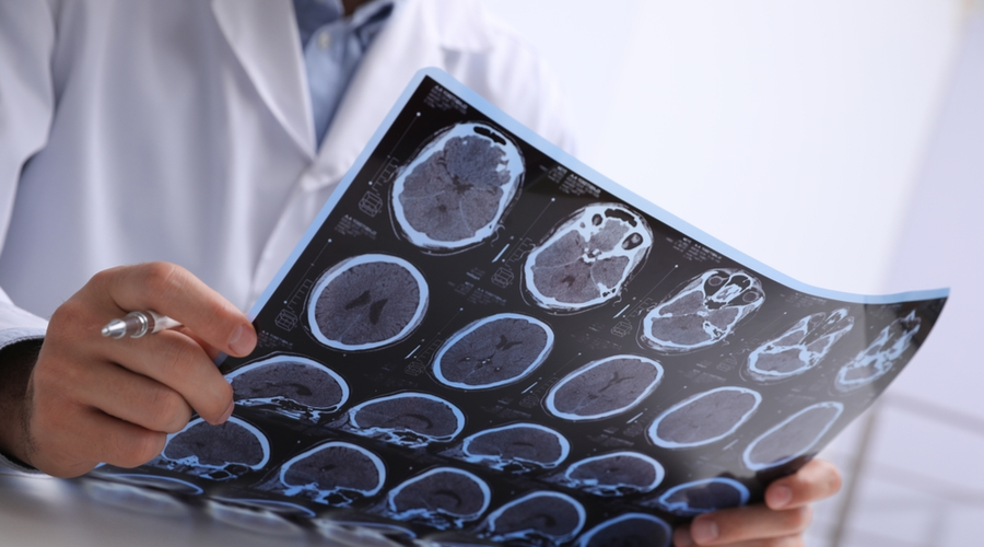 el-impacto-social-y-economico-de-la-epilepsia