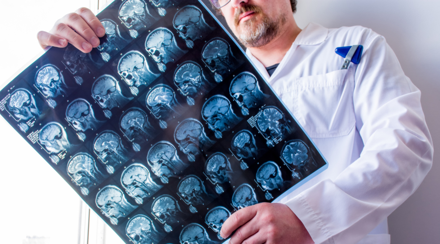 origen-de-la-epilepsia