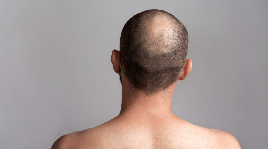 alopecia