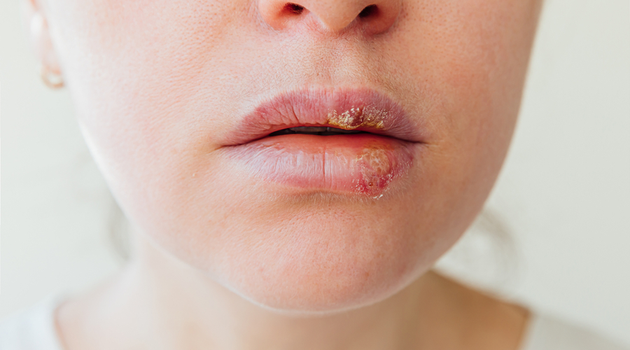herpes
