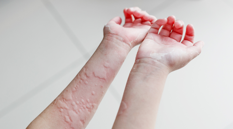 urticaria