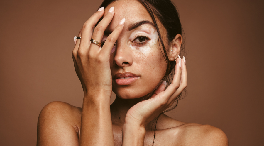 vitiligo
