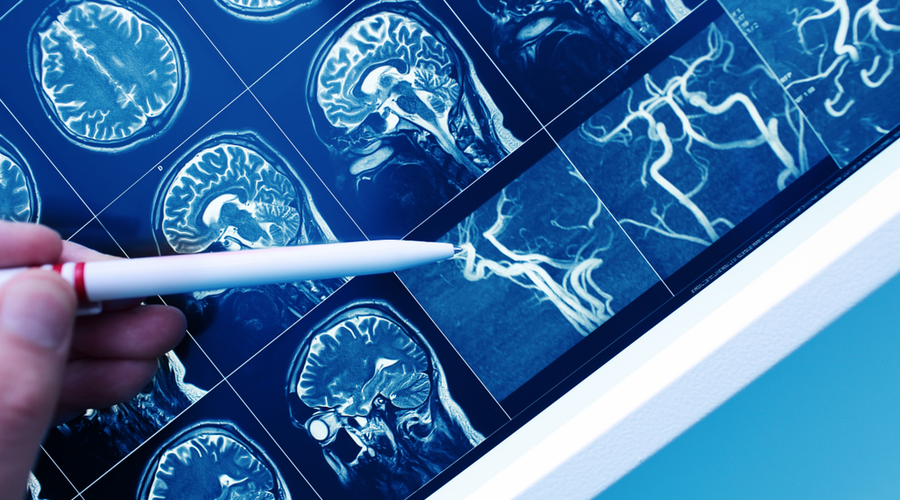 accidente-cerebrovascular